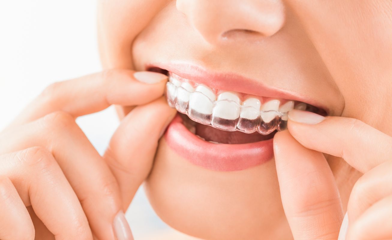 Correct Your Overbite with Invisalign