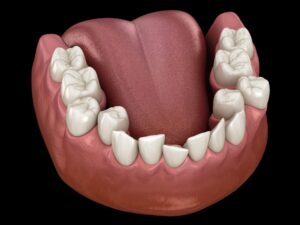 How to Fix Your Bite With Orthodontics